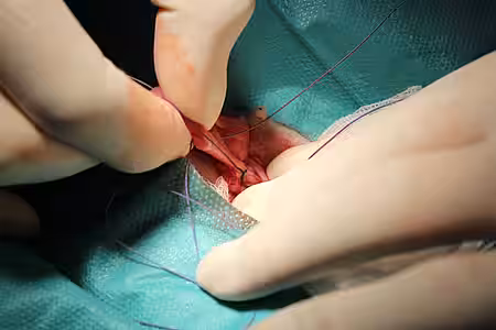 Abbinden des Eierstocks.