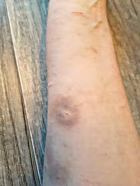 Unterarm Ann Kari Sieme